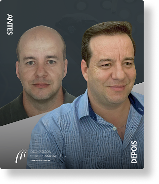 Antes e depois (1)(1)